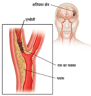 कैरोटिड धमनी को ब्लॉक करता हुआ रक्त का थक्का और थक्के को तोड़ते हुए एम्बोली। इनसेट मस्तिष्क के नुकसान को दर्शाता है।