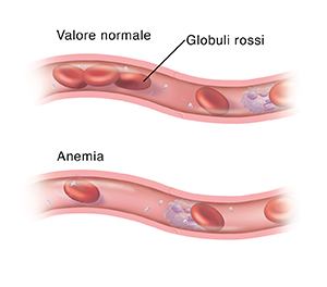Sezione trasversale di un vaso sanguigno con un numero normale di globuli rossi. Segue un'altra sezione trasversale di un vaso sanguigno che mostra un numero insufficiente di globuli rossi a causa dell'anemia.
