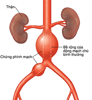 Mặt trước của động mạch chủ bụng với chứng phình động mạch. Đường chấm cho thấy chiều rộng bình thường của động mạch chủ.