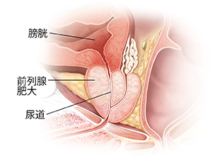增大的前列腺體剖面圖。