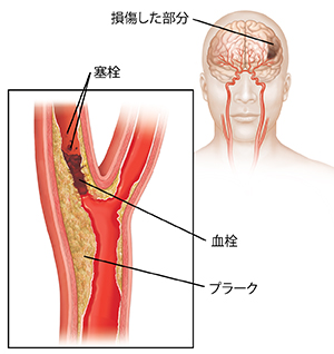 頸動脈を塞いでいる血栓と壊れた血栓によりできる塞栓。挿入図は、脳への損傷を示しています。