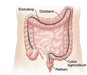 Schematische Darstellung des Bauchs mit über dem Anus in den Dickdarm eingeführtem Endoskop.