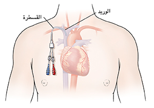 صورة توضيحية لصدر رجل تُظهر القلب إلى جانب خط مركزي مثبت في جسده.