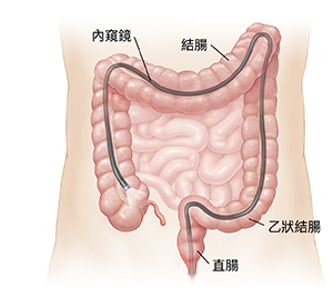 腹部輪廓圖,顯示通過肛門插入整個結腸的結腸鏡。