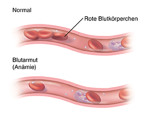 Querschnitt eines Blutgefäßes mit einer normalen Menge an roten Blutkörperchen. Darunter ein Querschnitt eines Blutgefäßes mit einer zu geringen Menge an roten Blutkörperchen aufgrund von Blutarmut (Anämie).