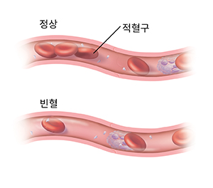 요도 다음은 빈혈로 인해 적혈구 수가 지나치게 적은 혈관을 보여주는 또 하나의 단면도입니다.