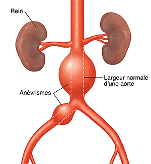 Vue antérieure d'anévrismes dans une aorte abdominale. La ligne en pointillés indique la largeur normale d'une aorte.
