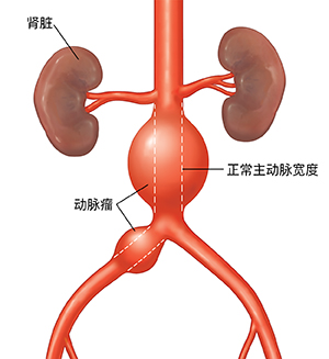 有动脉瘤的腹主动脉前视图。虚线显示主动脉的正常宽度。