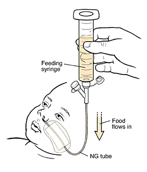 Hand holding syringe attached to child’s NG feeding tube with food flowing from syringe into tube.