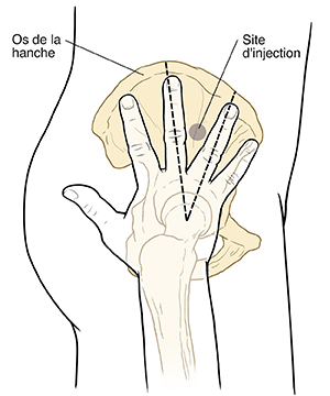 Schéma latéral du bas du corps, de la hanche et de la cuisse avec les os du bassin et de la jambe. La main avec les doigts écartés et la paume vers le bas où l'os de la jambe rencontre la hanche. Ligne en pointillé autour du cercle entre le majeur et l'annulaire.